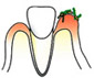 カビが歯茎について根を下ろし炎症