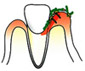 歯ぐきが腫れ、歯と歯ぐきの間の溝が汚れやすくなり、